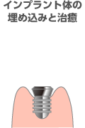インプラント体の埋め込みと治癒