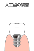 人工歯の装着