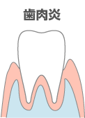 歯肉炎